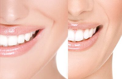 blog4 (1) Smile Makeover