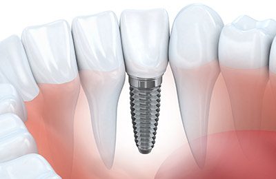 preventive_dentistry Implant Dentistry